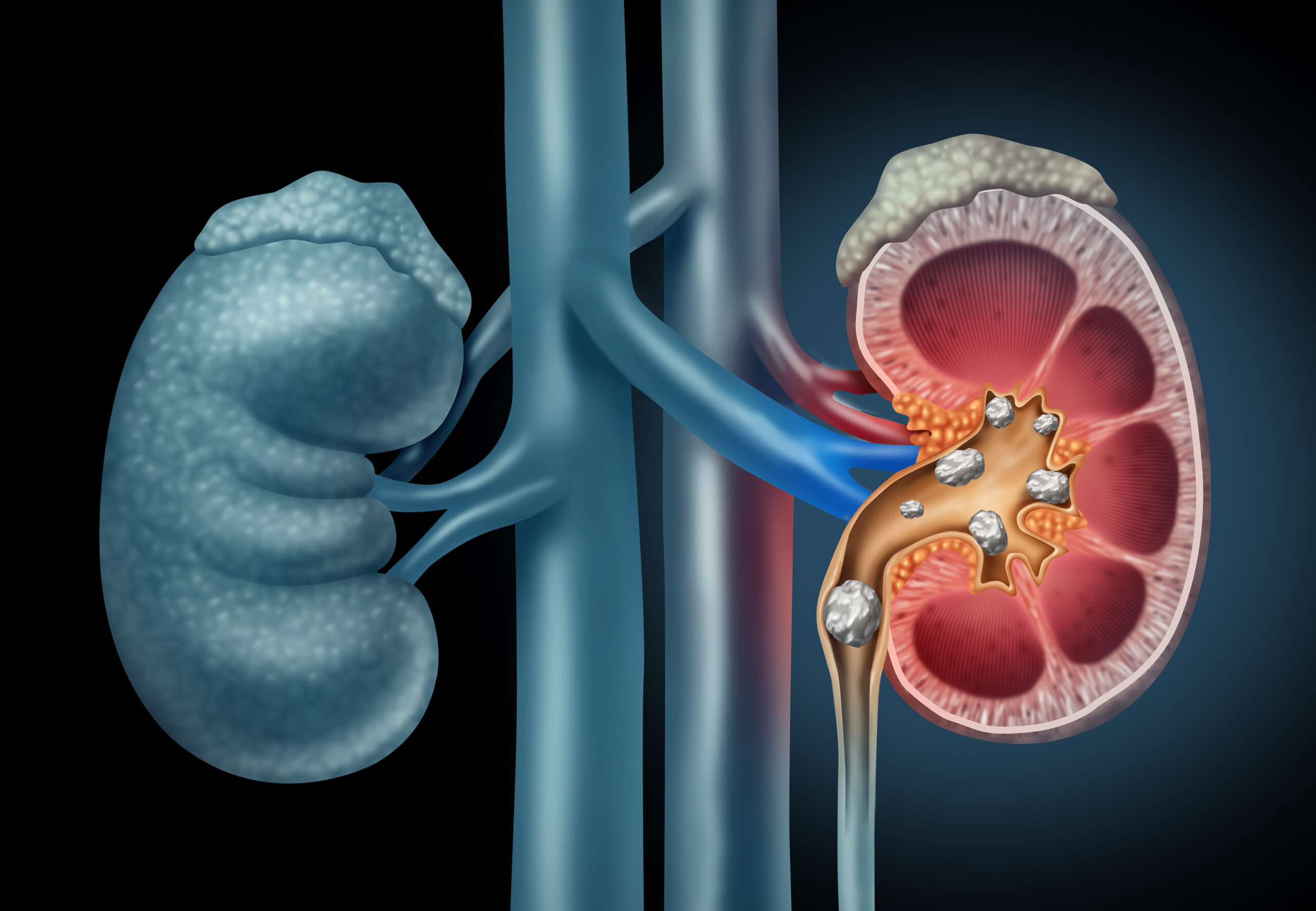 Kidney Stone Causes Symptoms Treatment and Prevention