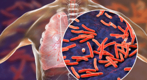 Punjab Falling Behind in Tuberculosis Screening: Only 15% of High-Risk People Checked