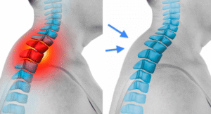 That Neck Hump on Your Back? It’s More Than Just Bad Posture
